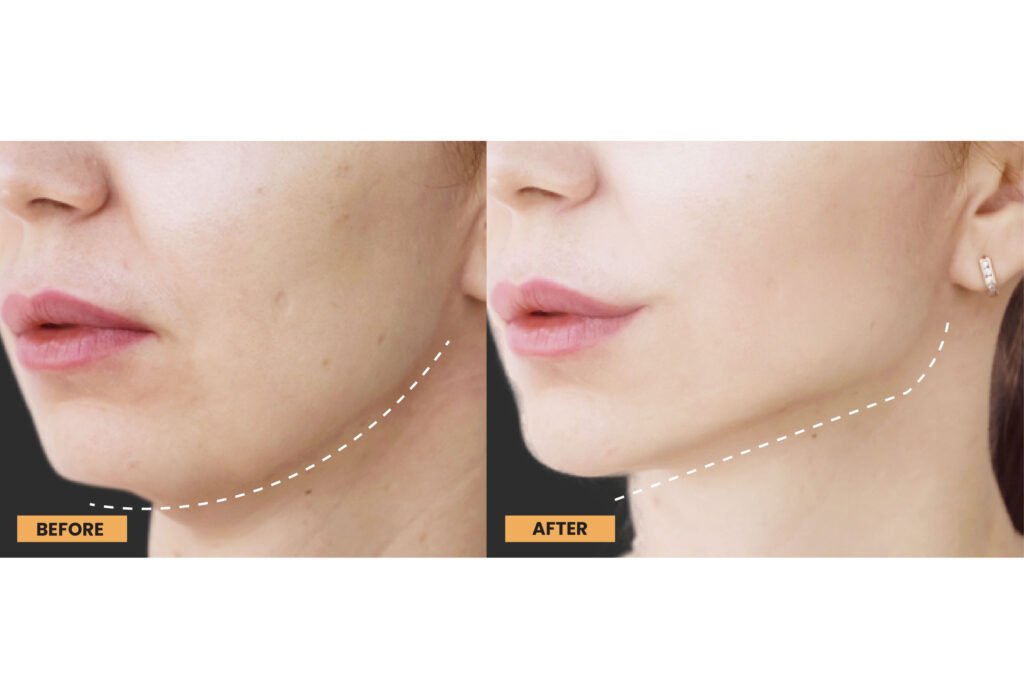 Tarik benang wajah adalah solusi efektif dan minim invasif untuk mengencangkan kulit dan mengurangi tanda-tanda penuaan.